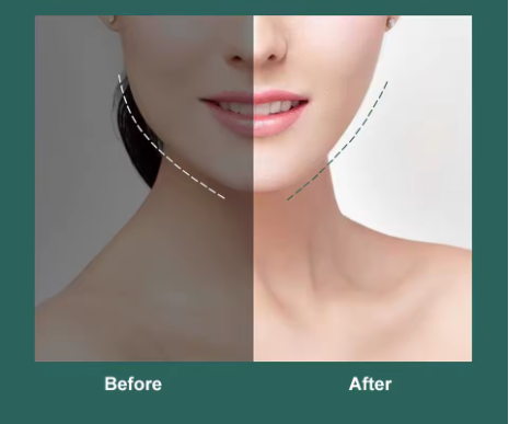 Faja Reductora de Papada y Lifting Facial V-Line (Reafirmante y Modeladora)